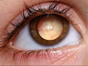 retinoblastoma