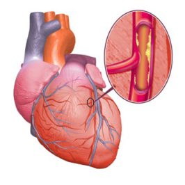 Основные признаки ишемии сердца