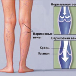 Как лечить варикоз на ногах
