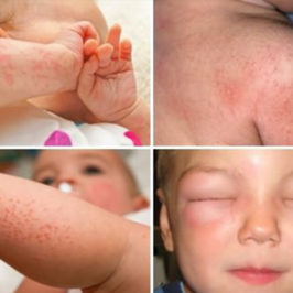 Аллергия на теле – не беда! Метод лечения с помощью ТДИ-01 «Третье дыхание»